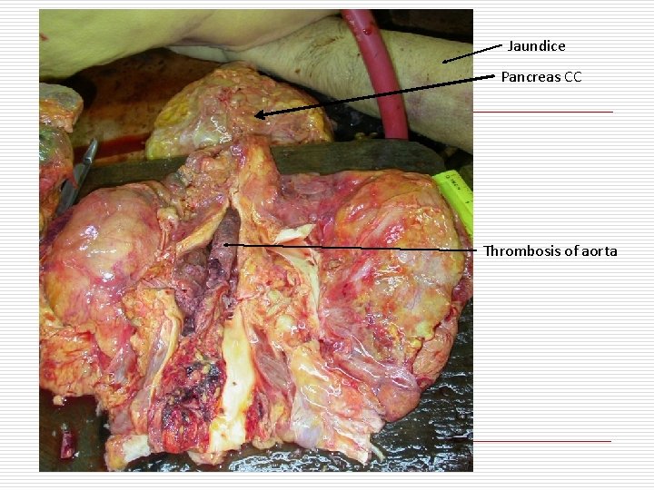 Jaundice Pancreas CC Thrombosis of aorta 