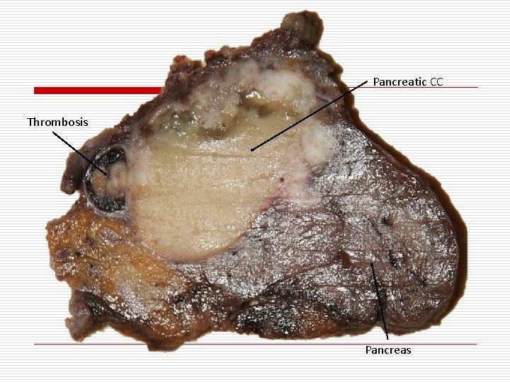 Pancreatic CC Thrombosis Pancreas 