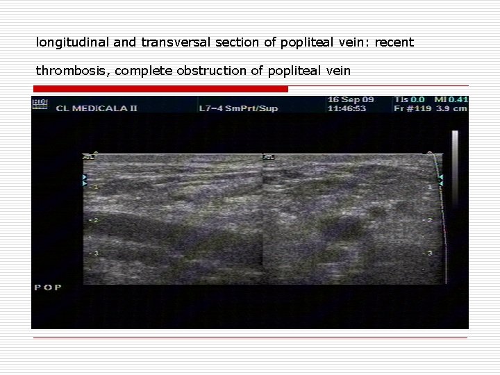 longitudinal and transversal section of popliteal vein: recent thrombosis, complete obstruction of popliteal vein