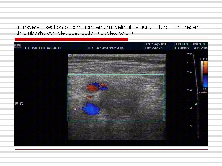 transversal section of common femural vein at femural bifurcation: recent thrombosis, complet obstruction (duplex