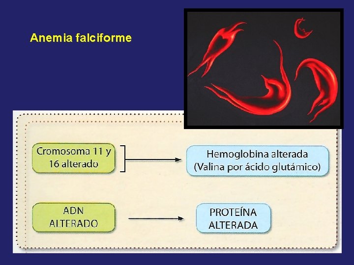 Anemia falciforme 