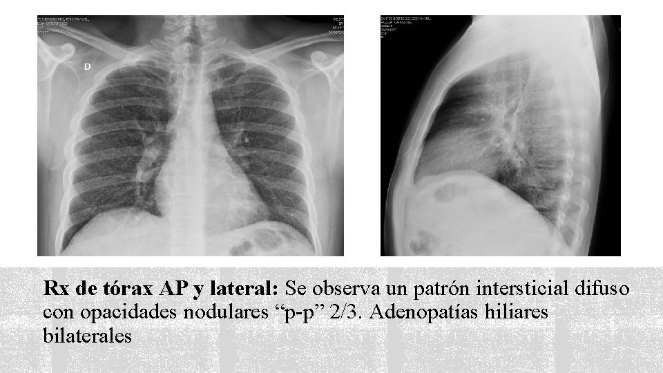 Rx de tórax AP y lateral: Se observa un patrón intersticial difuso con opacidades