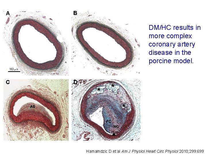 DM/HC results in more complex coronary artery disease in the porcine model. Hamamdzic D