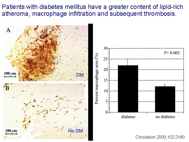 Patients with diabetes mellitus have a greater content of lipid-rich atheroma, macrophage infiltration and