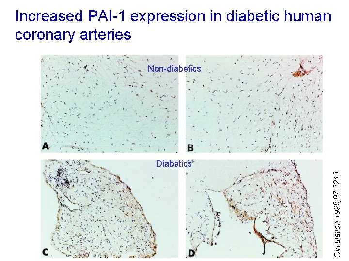 Increased PAI-1 expression in diabetic human coronary arteries Non-diabetics Circulation 1998; 97: 2213 Diabetics