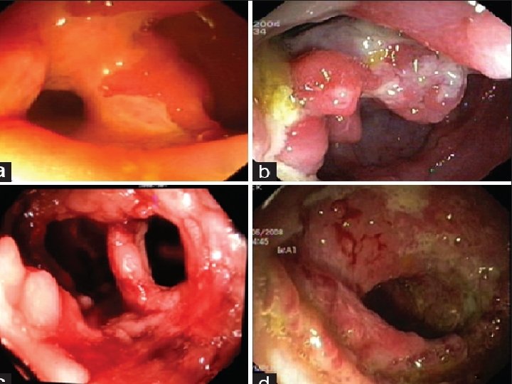 ANATOMO-PATHOLOGIE 1 -Macroscopie: A. Forme intestinale: I. Forme ulcéreuse : ü ulcères uniques ou