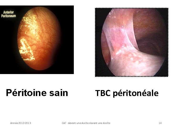 Péritoine sain Année 2012 -2013 TBC péritonéale CAT devant une Ascite 14 
