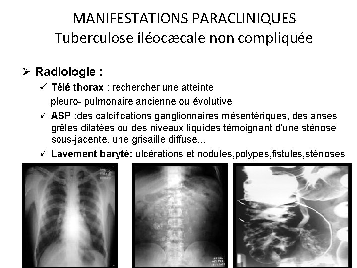 MANIFESTATIONS PARACLINIQUES Tuberculose iléocæcale non compliquée Ø Radiologie : ü Télé thorax : recher