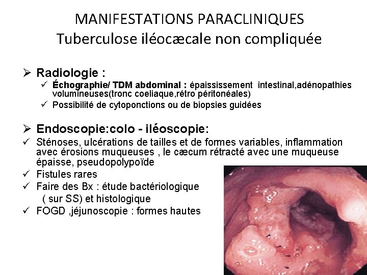 MANIFESTATIONS PARACLINIQUES Tuberculose iléocæcale non compliquée Ø Radiologie : ü Échographie/ TDM abdominal :