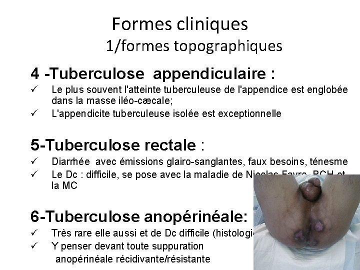 Formes cliniques 1/formes topographiques 4 -Tuberculose appendiculaire : ü ü Le plus souvent l'atteinte