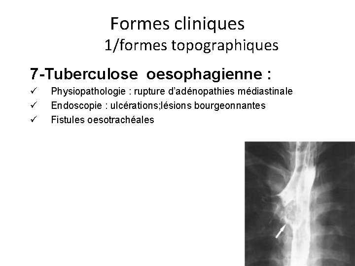 Formes cliniques 1/formes topographiques 7 -Tuberculose oesophagienne : ü ü ü Physiopathologie : rupture