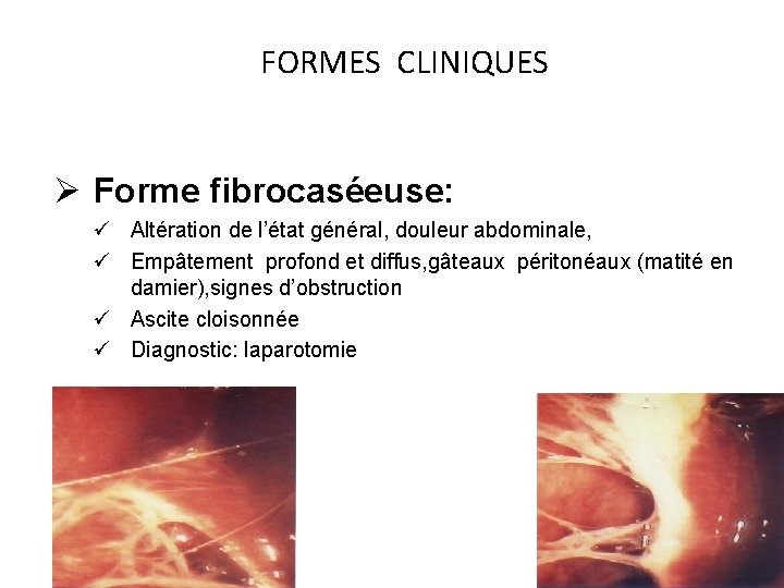 FORMES CLINIQUES Ø Forme fibrocaséeuse: ü Altération de l’état général, douleur abdominale, ü Empâtement