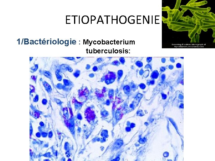 ETIOPATHOGENIE 1/Bactériologie : Mycobacterium tuberculosis: 