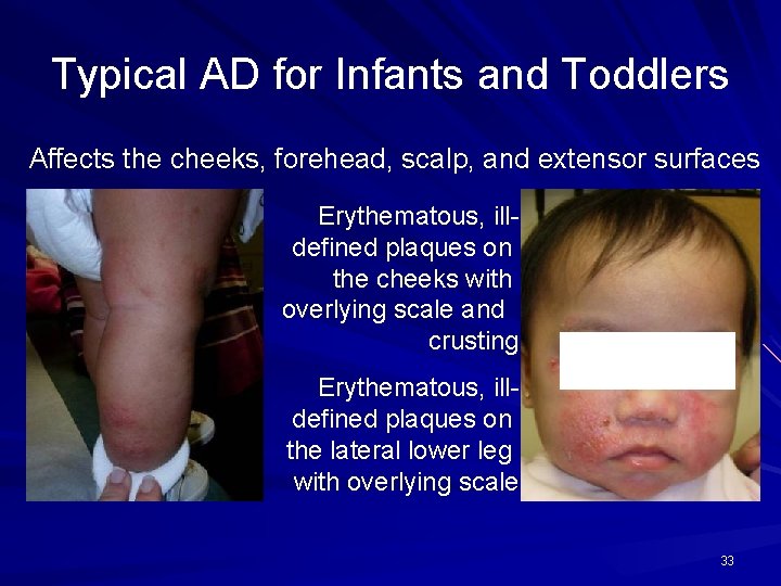 Typical AD for Infants and Toddlers Affects the cheeks, forehead, scalp, and extensor surfaces