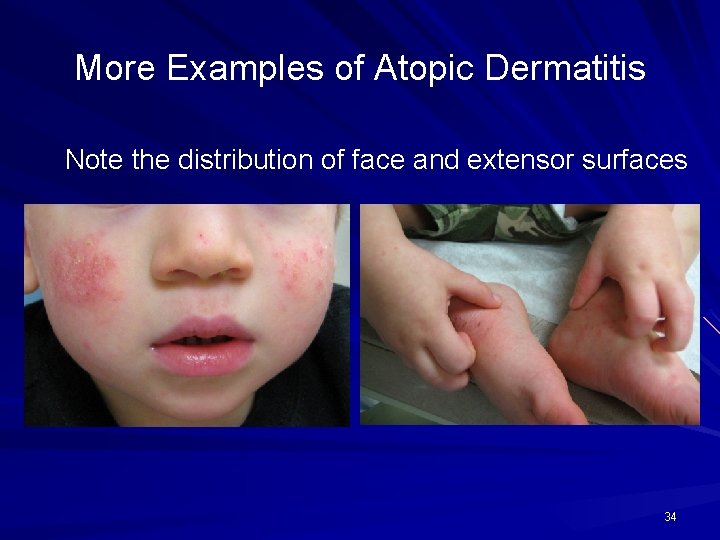 More Examples of Atopic Dermatitis Note the distribution of face and extensor surfaces 34