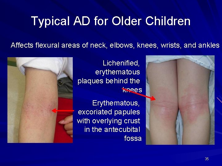 Typical AD for Older Children Affects flexural areas of neck, elbows, knees, wrists, and