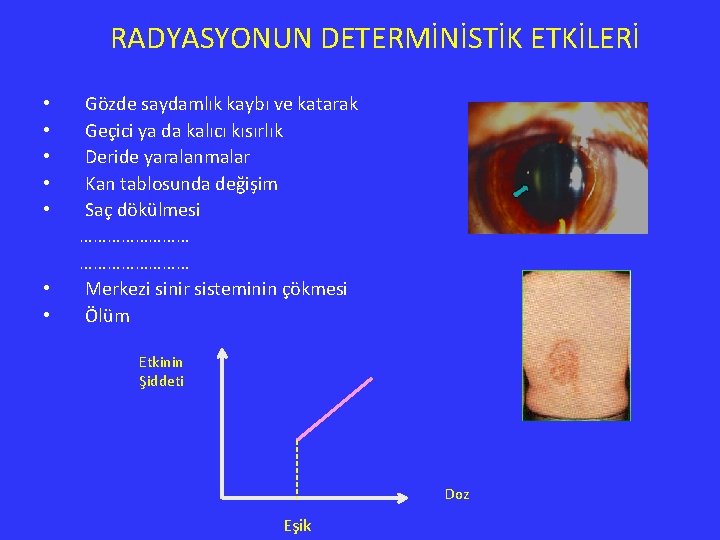 RADYASYONUN DETERMİNİSTİK ETKİLERİ • Gözde saydamlık kaybı ve katarak • Geçici ya da kalıcı