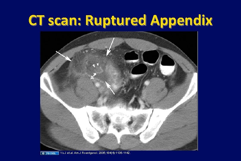 CT scan: Ruptured Appendix Yu J et al. Am J Roentgenol. 2005; 184(4): 1136