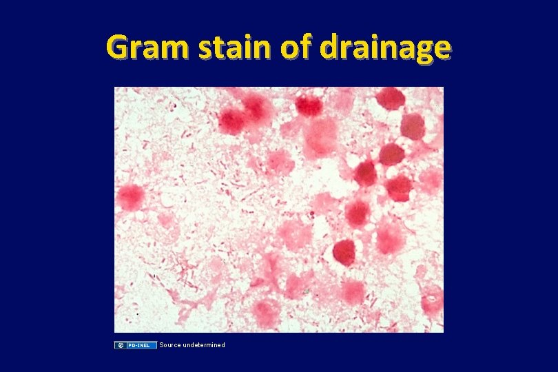 Gram stain of drainage Source undetermined 