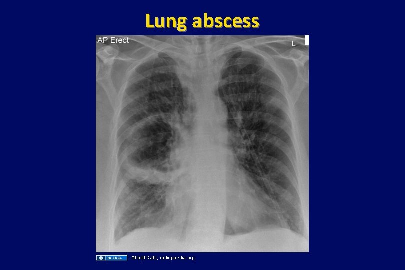 Lung abscess Abhijit Datir, radiopaedia. org 