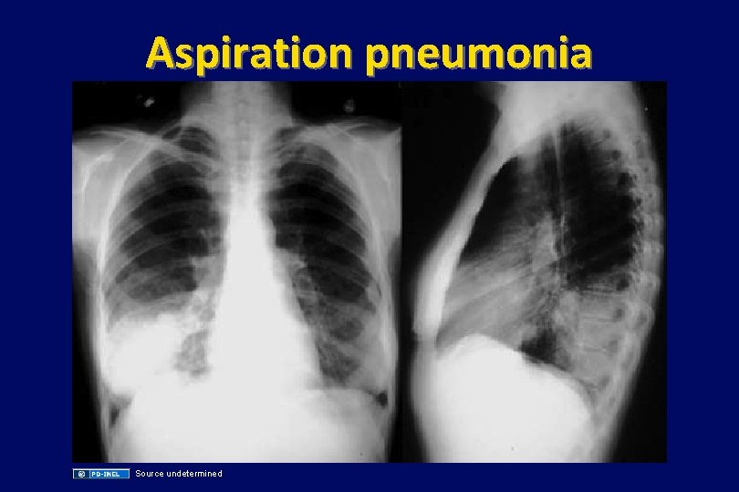 Aspiration pneumonia Source undetermined 