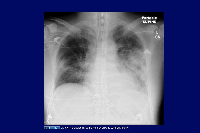 Lin D, Suwanantarat Nm Young RS. Hawaii Med J 2010; 69(7): 161 -3 