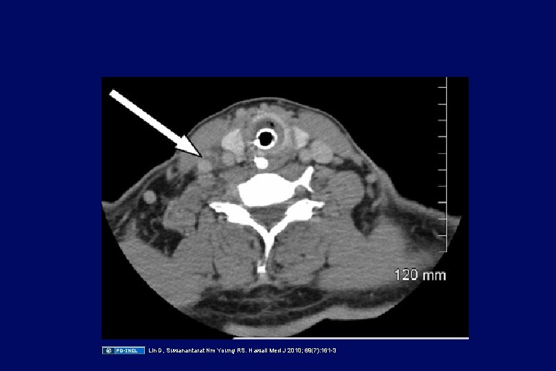 Lin D, Suwanantarat Nm Young RS. Hawaii Med J 2010; 69(7): 161 -3 