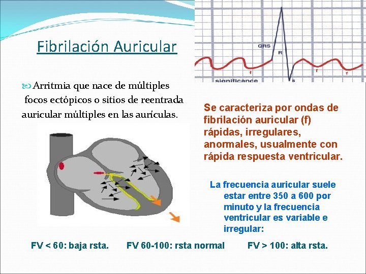 Fibrilación Auricular Arritmia que nace de múltiples focos ectópicos o sitios de reentrada auricular