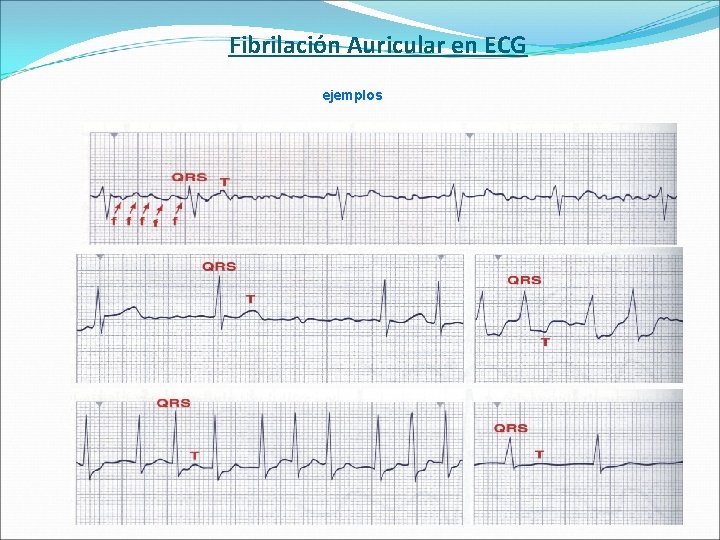 Fibrilación Auricular en ECG ejemplos 