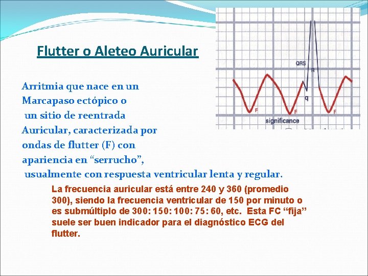 Flutter o Aleteo Auricular Arritmia que nace en un Marcapaso ectópico o un sitio