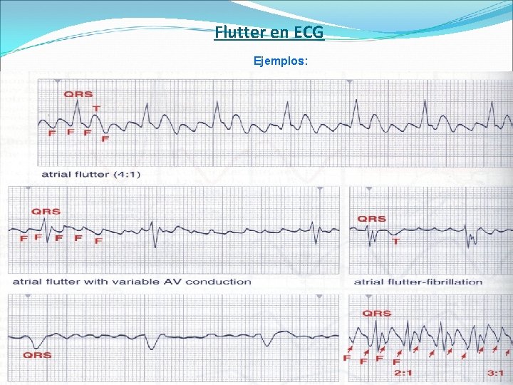 Flutter en ECG Ejemplos: 