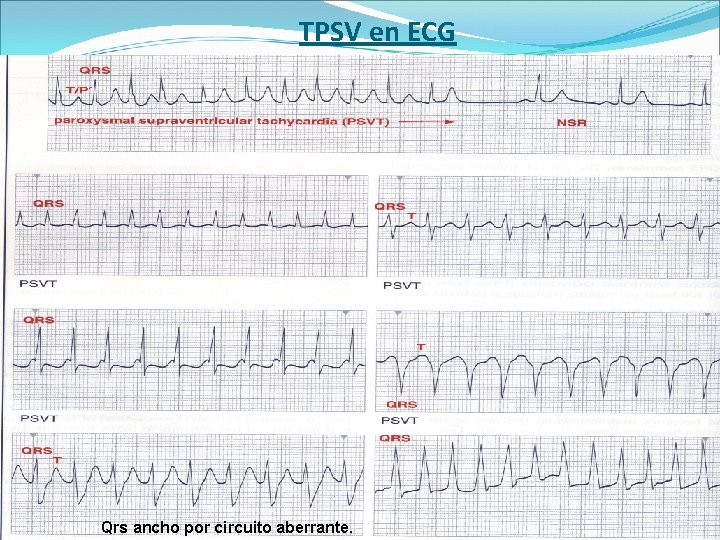 TPSV en ECG Qrs ancho por circuito aberrante. 