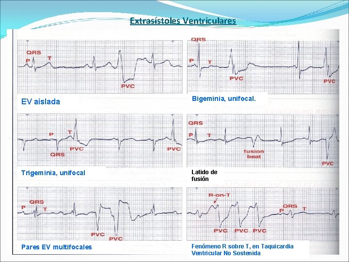 Extrasístoles Ventriculares EV aislada Bigeminia, unifocal. Trigeminia, unifocal Latido de fusión Pares EV multifocales