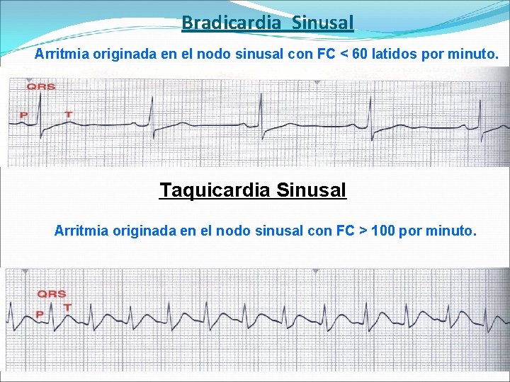 Bradicardia Sinusal Arritmia originada en el nodo sinusal con FC < 60 latidos por