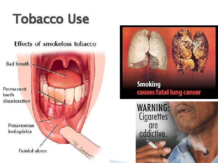 Tobacco Use 