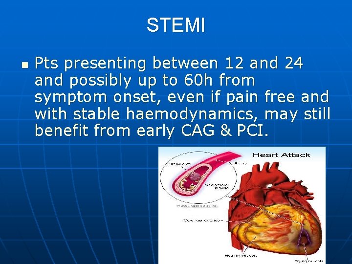 STEMI n Pts presenting between 12 and 24 and possibly up to 60 h