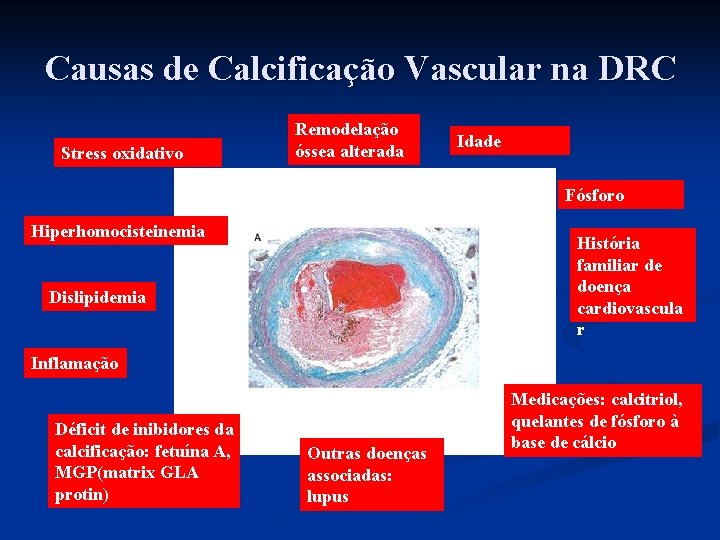 Causas de Calcificação Vascular na DRC Stress oxidativo Remodelação óssea alterada Idade Fósforo Hiperhomocisteinemia