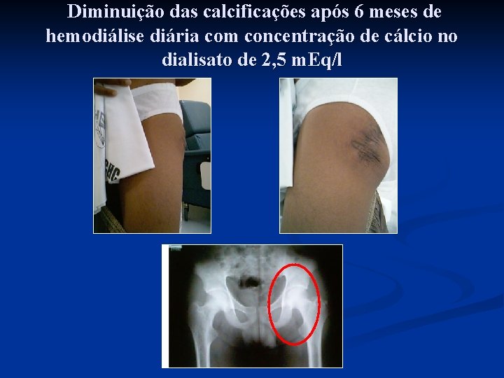 Diminuição das calcificações após 6 meses de hemodiálise diária com concentração de cálcio no