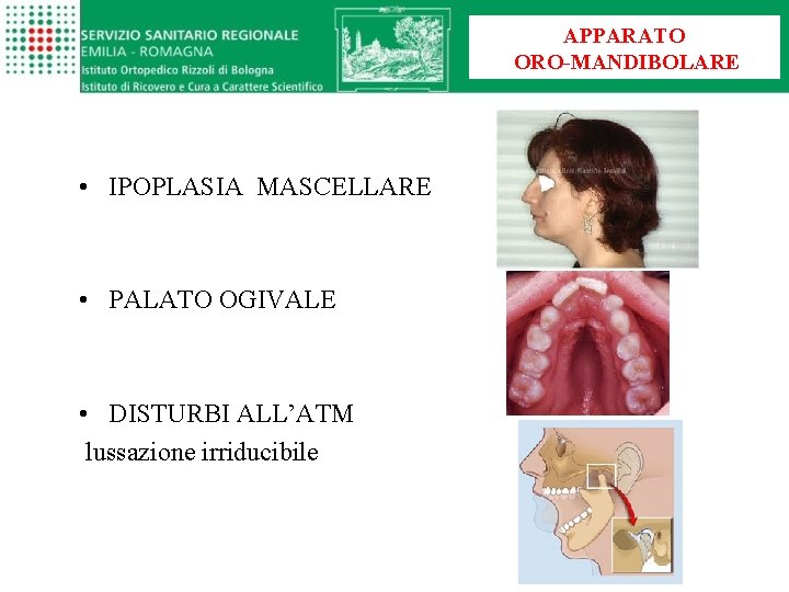 APPARATO ORO-MANDIBOLARE • IPOPLASIA MASCELLARE • PALATO OGIVALE • DISTURBI ALL’ATM lussazione irriducibile 