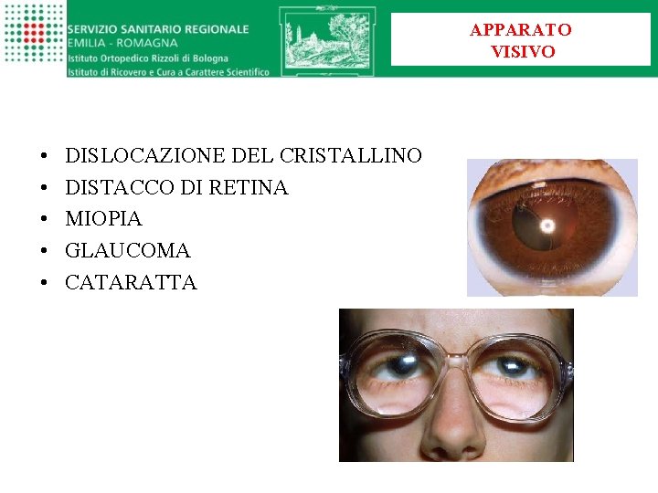 APPARATO VISIVO • • • DISLOCAZIONE DEL CRISTALLINO DISTACCO DI RETINA MIOPIA GLAUCOMA CATARATTA