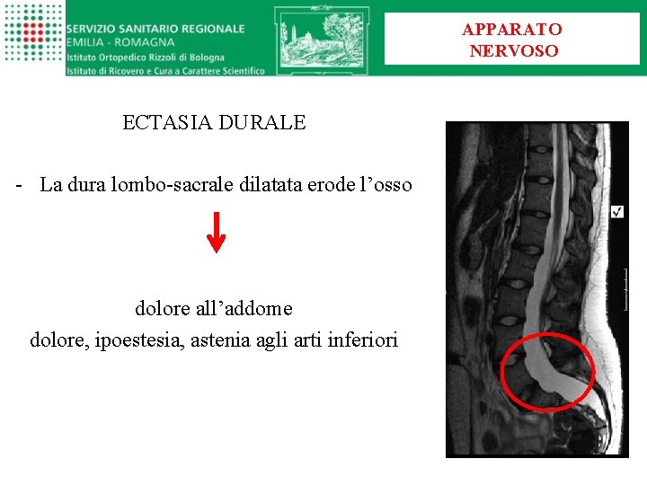 APPARATO NERVOSO ECTASIA DURALE - La dura lombo-sacrale dilatata erode l’osso dolore all’addome dolore,