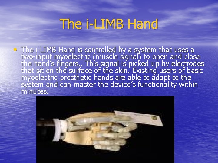 The i-LIMB Hand • The i-LIMB Hand is controlled by a system that uses