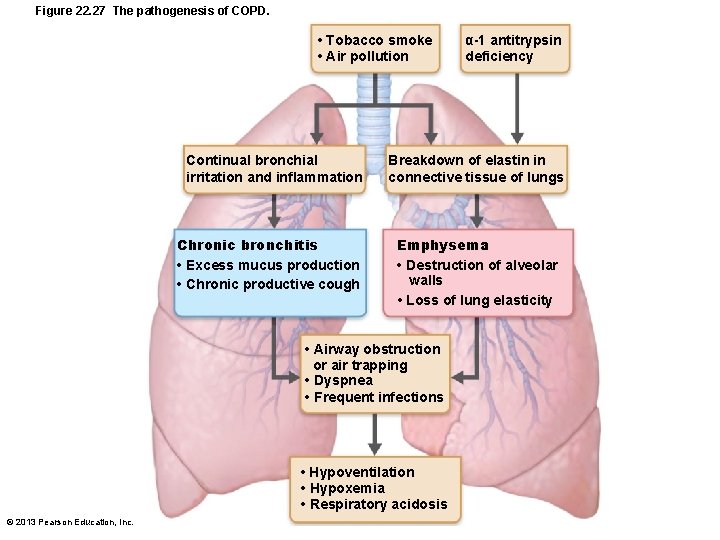 Figure 22. 27 The pathogenesis of COPD. • Tobacco smoke • Air pollution Continual