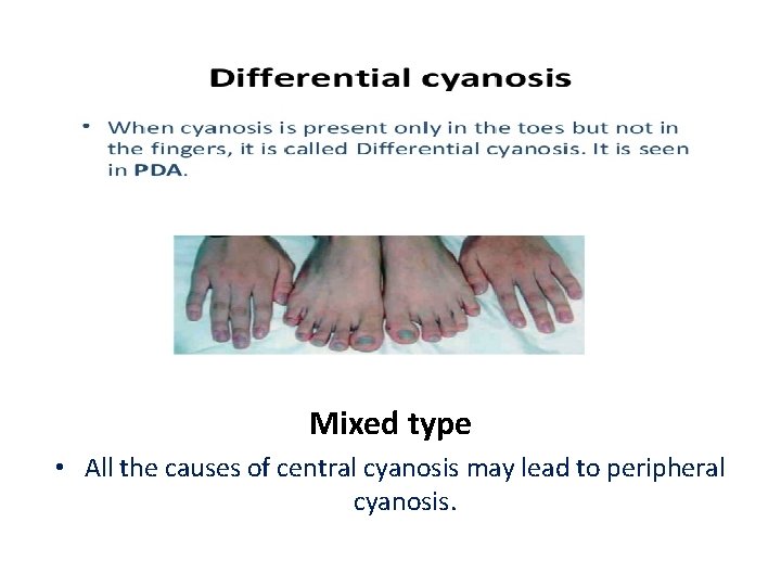 Mixed type • All the causes of central cyanosis may lead to peripheral cyanosis.