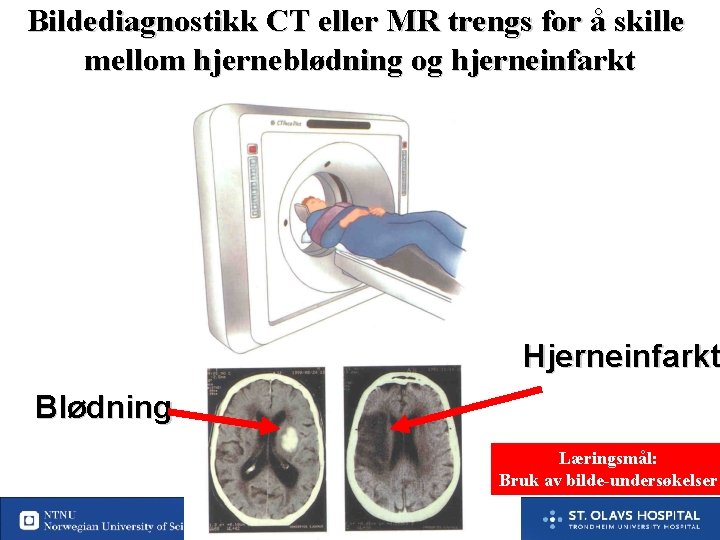 Bildediagnostikk CT eller MR trengs for å skille mellom hjerneblødning og hjerneinfarkt Hjerneinfarkt Blødning