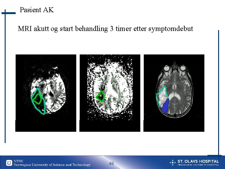 Pasient AK MRI akutt og start behandling 3 timer etter symptomdebut T 2 MR