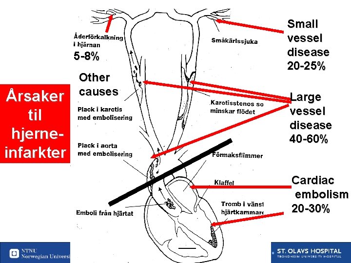 Small vessel disease 20 -25% 5 -8% Årsaker til hjerneinfarkter Other causes Large vessel