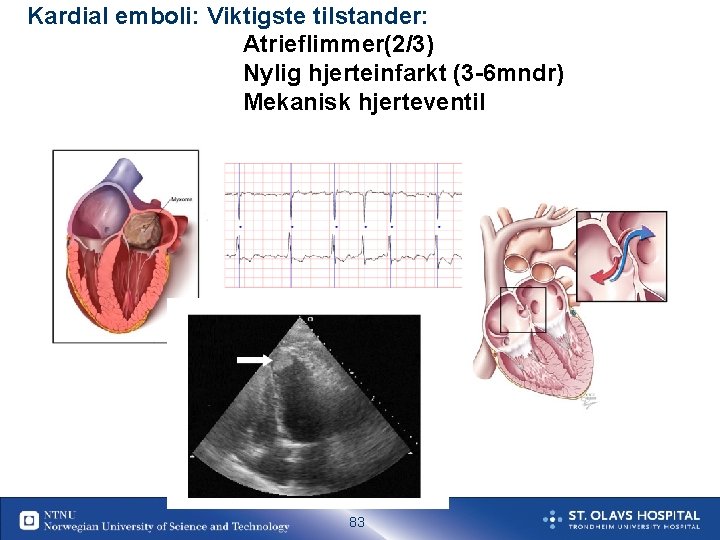 Kardial emboli: Viktigste tilstander: Atrieflimmer(2/3) Nylig hjerteinfarkt (3 -6 mndr) Mekanisk hjerteventil 83 