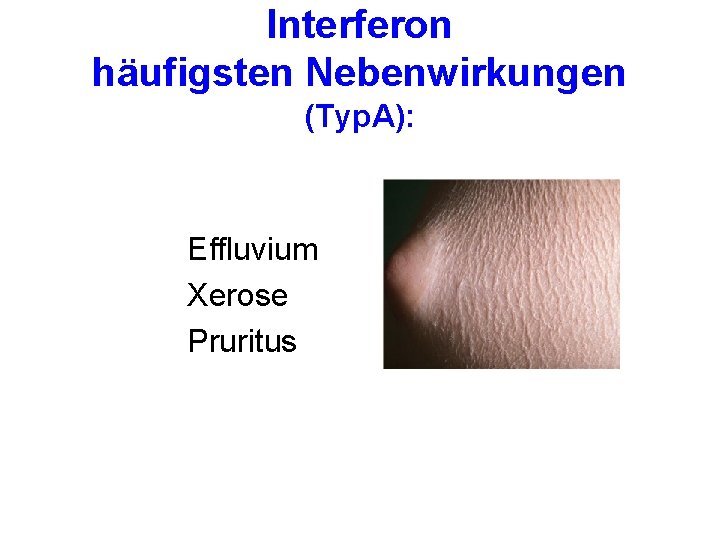 Interferon häufigsten Nebenwirkungen (Typ. A): Effluvium Xerose Pruritus 