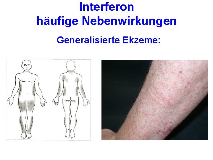 Interferon häufige Nebenwirkungen Generalisierte Ekzeme: 